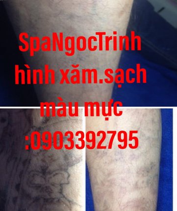 xóa hình xăm spangoctrinh1.jpg